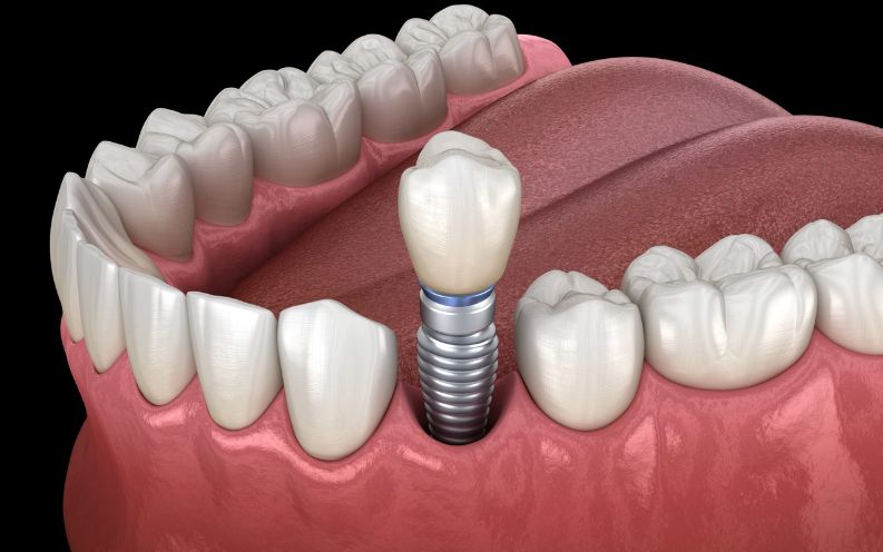 Featured image for “8 Warning Signs That Your Dental Implant Might Be Failing”