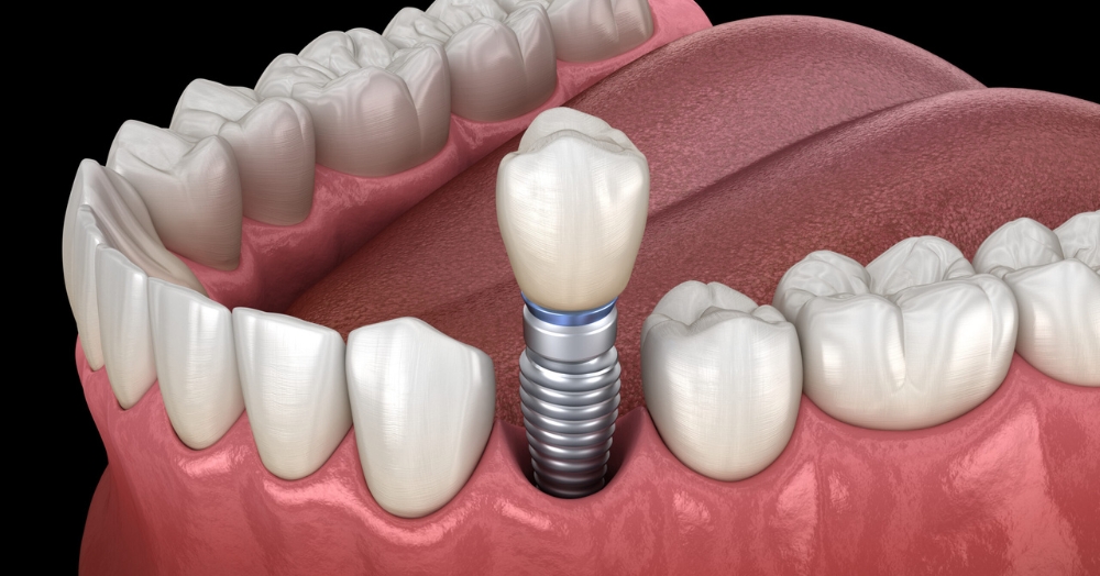 Should I Get Titanium or Zirconia Dental Implants