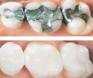 White Composite Fillings Bellevue PA