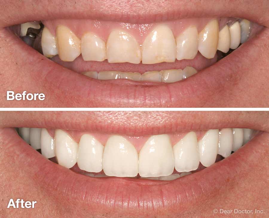 Smile Makeover Bellevue