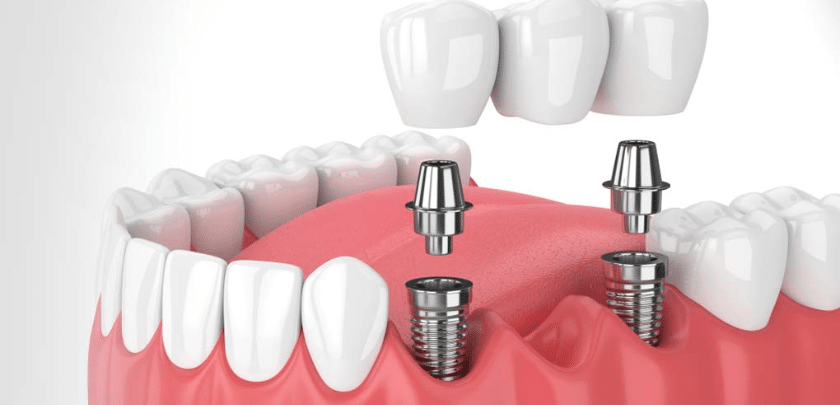 How Much Does It Cost To Remove A Dental Implant