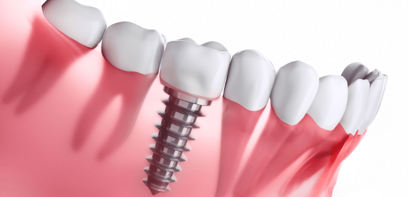 Is A Dental Implant For Teeth Good Or Bad?