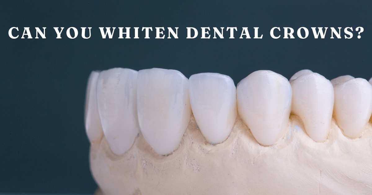 can you whiten dental crowns