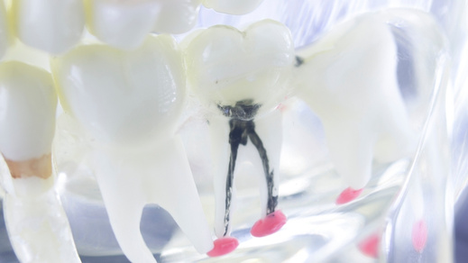why do teeth need root canals