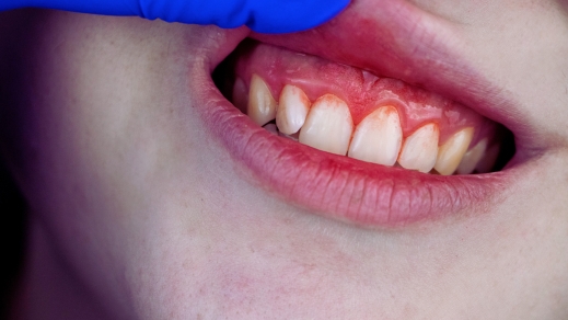 can you cure gum disease at home