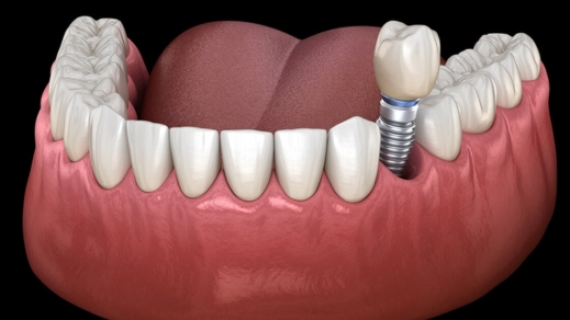 how long to wait for dental implants after extraction