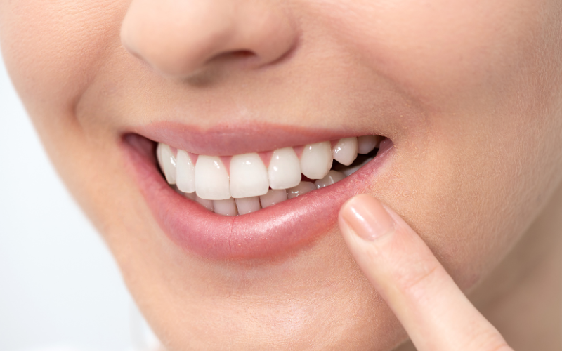 Teeth whitening treatments