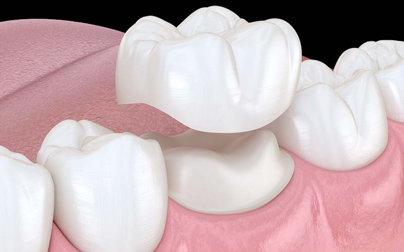 Dental Crowns For Front Teeth