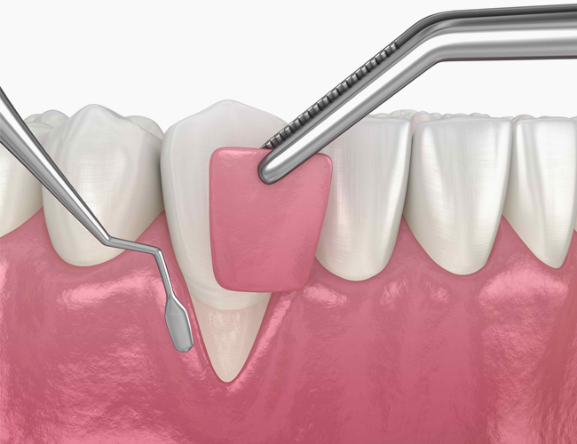 crown lengthening matthews nc