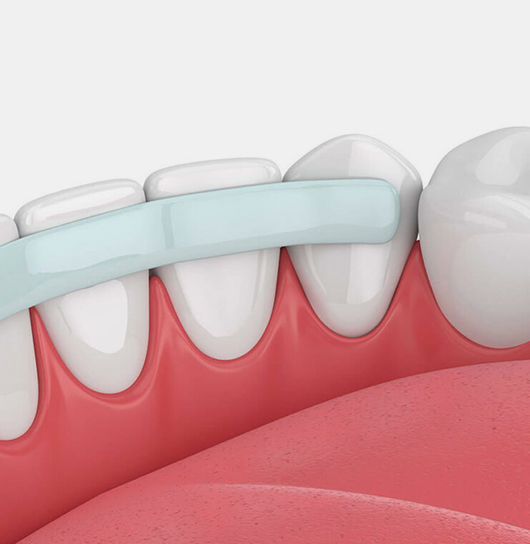 dental bonding matthews nc