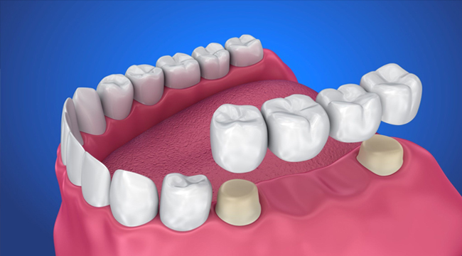 dental crown and bridges matthews nc