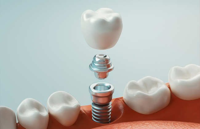 dental implants matthews nc