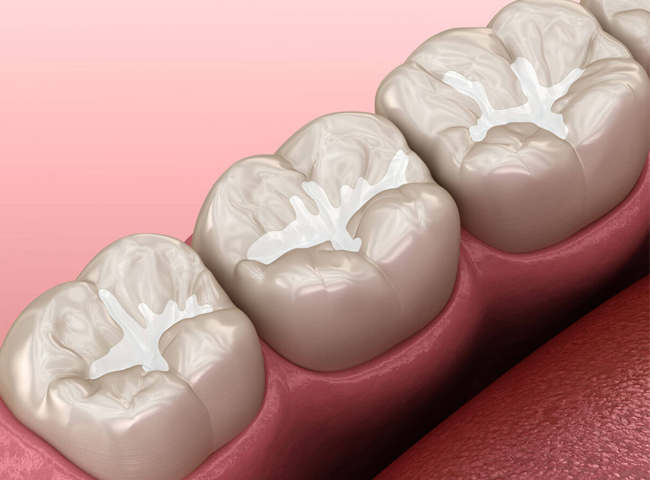 dental sealants matthews nc