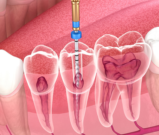 endodontic surgery matthews nc