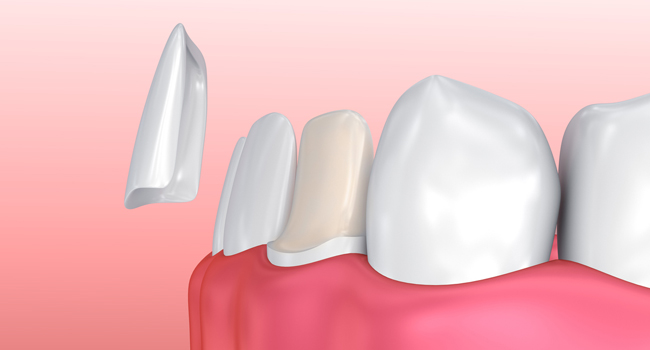 porcelain veneers matthews nc
