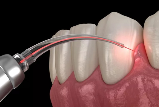 soft tissue laser in matthews nc