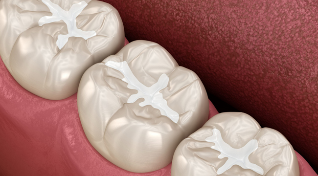 white fillings matthews nc