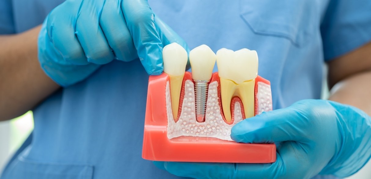 myths and misconceptions about root canals