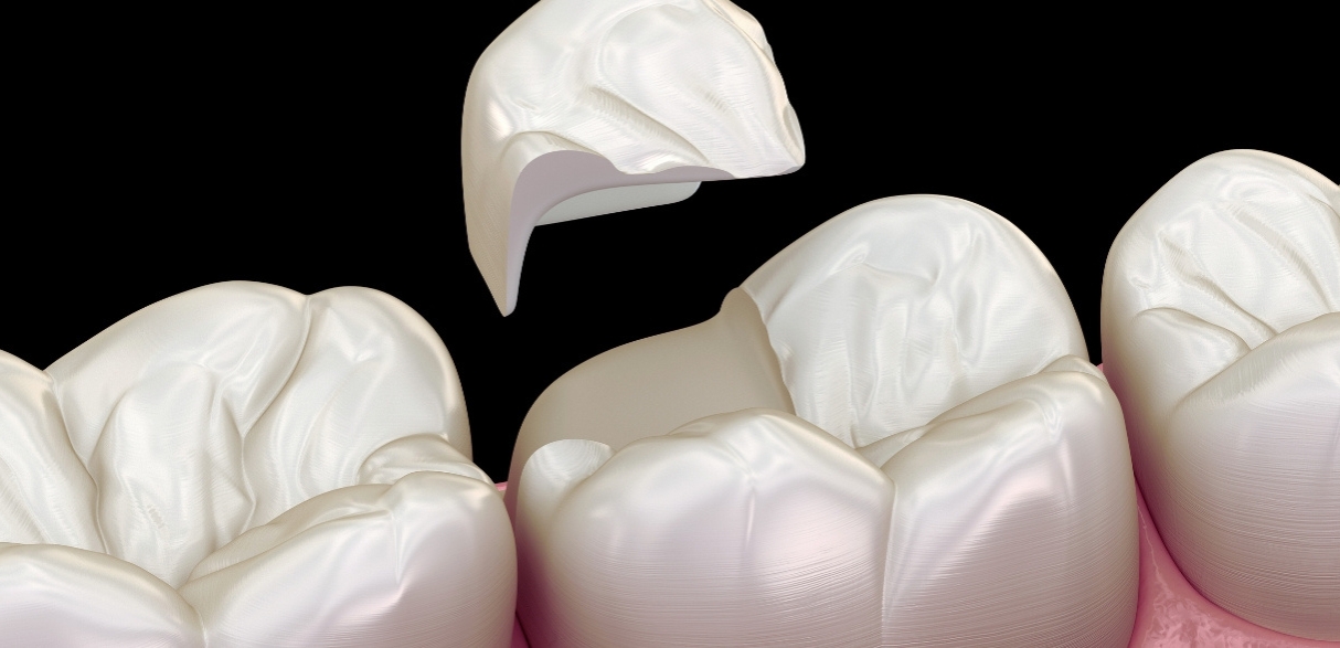the benefits of composite fillings