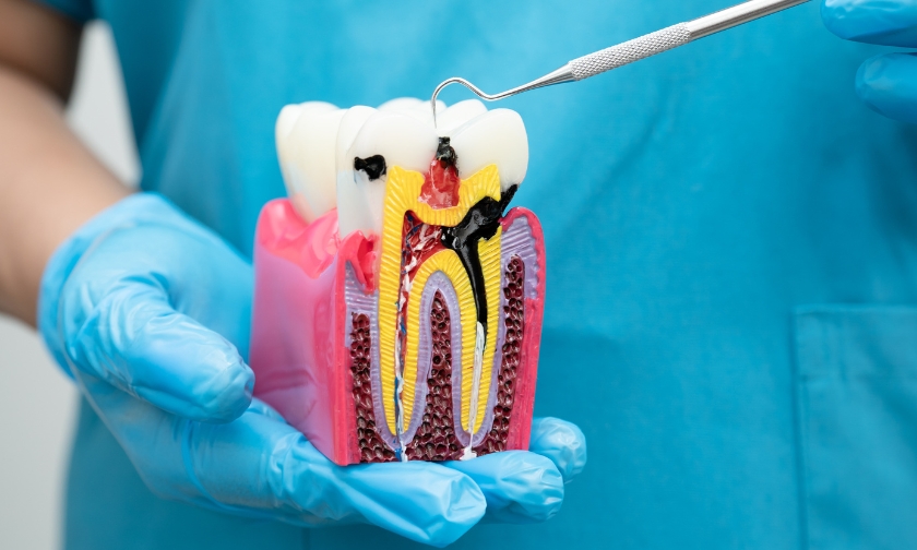 Root Canal Treatment: Why It's a Tooth-Saving Solution