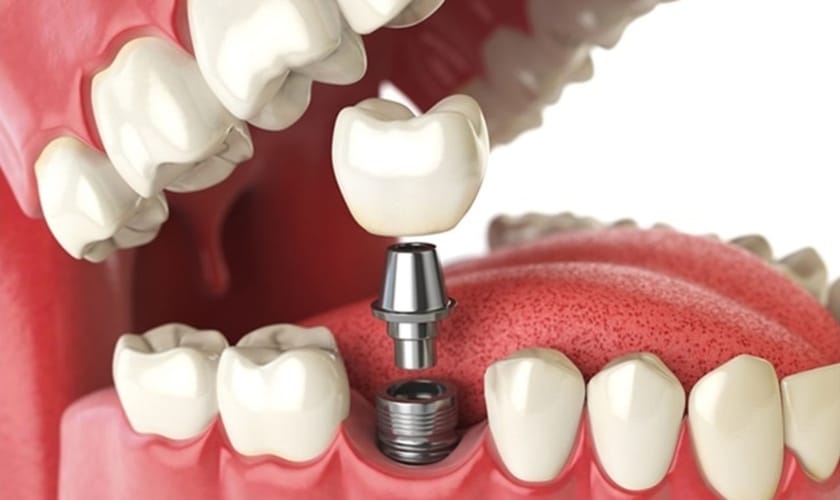 Featured image for “Maintaining Dental Implants: Tips for Long-Lasting Results in Havertown, PA”