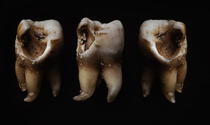 Featured image for “Can Black Spots On Teeth Be Removed?”