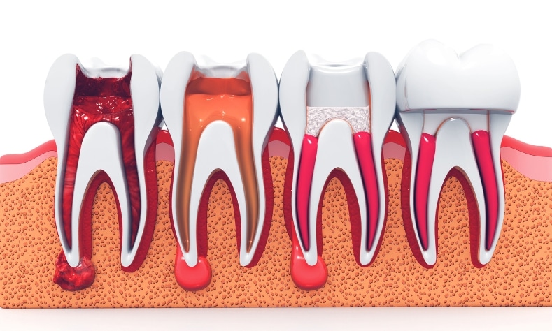 Featured image for “Root Canal Aftercare: Tips For A Smooth Recovery”