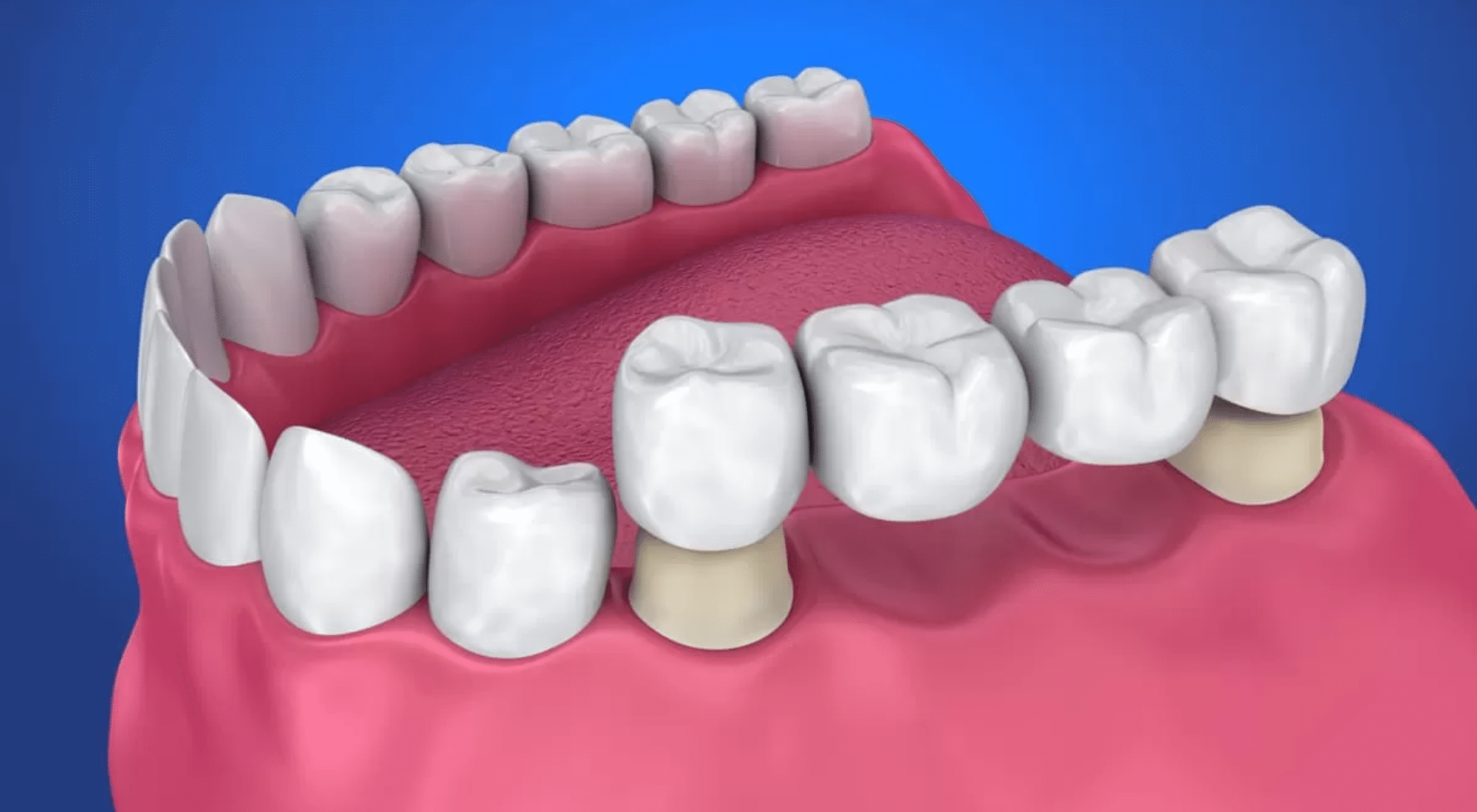 Inspect the Teeth: Check the teeth that support the bridge. Look for signs of tooth decay, damage, or sensitivity