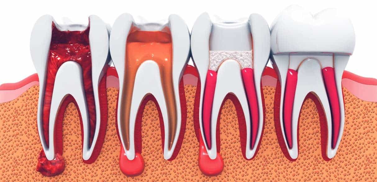 what to ask your dentist before a root canal
