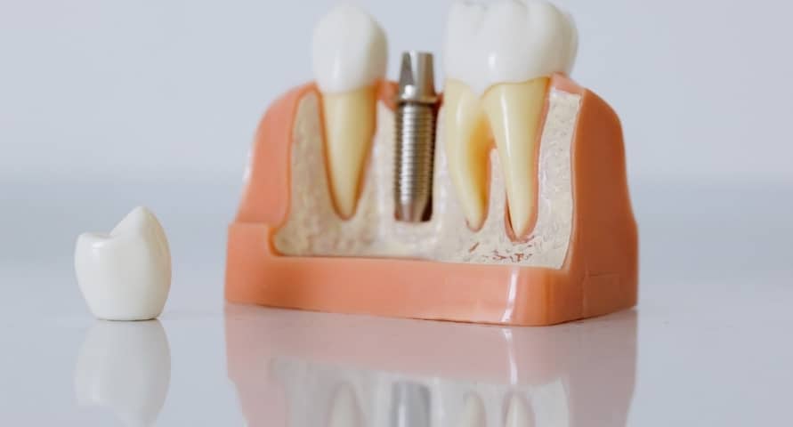 the life-changing benefits of dental implants