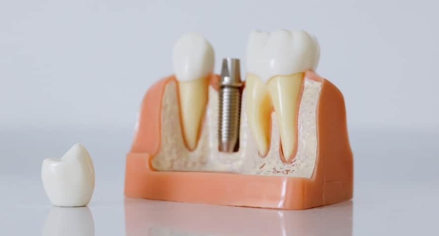 how long do dental implants last