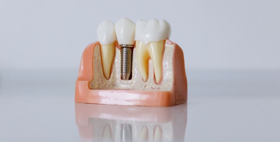 why dental implants look and feel more natural than other options