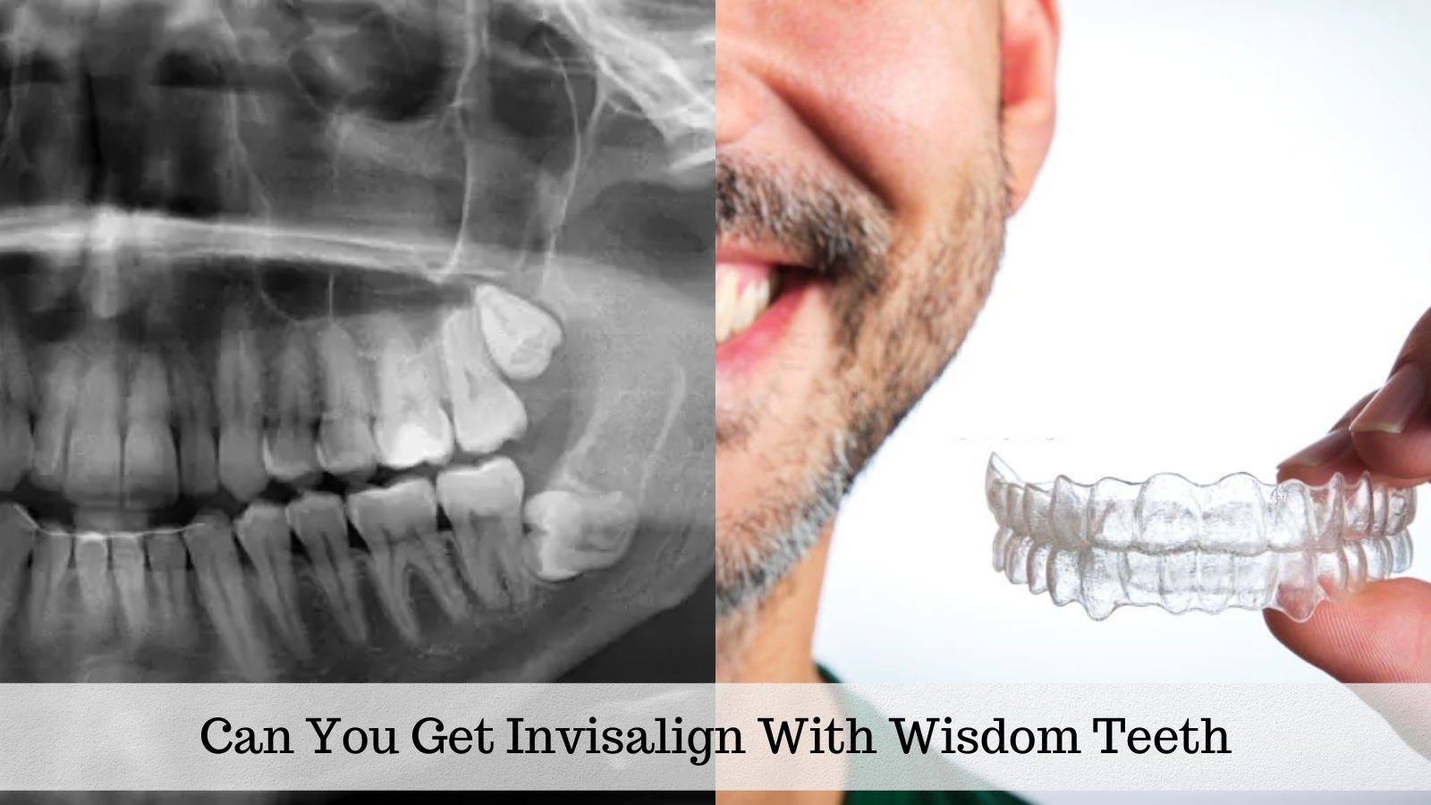 can-you-get-invisalign-with-wisdom-teeth