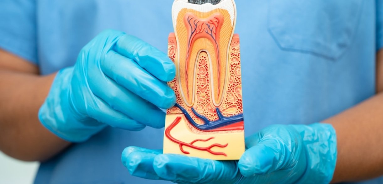 pain management after a root canal