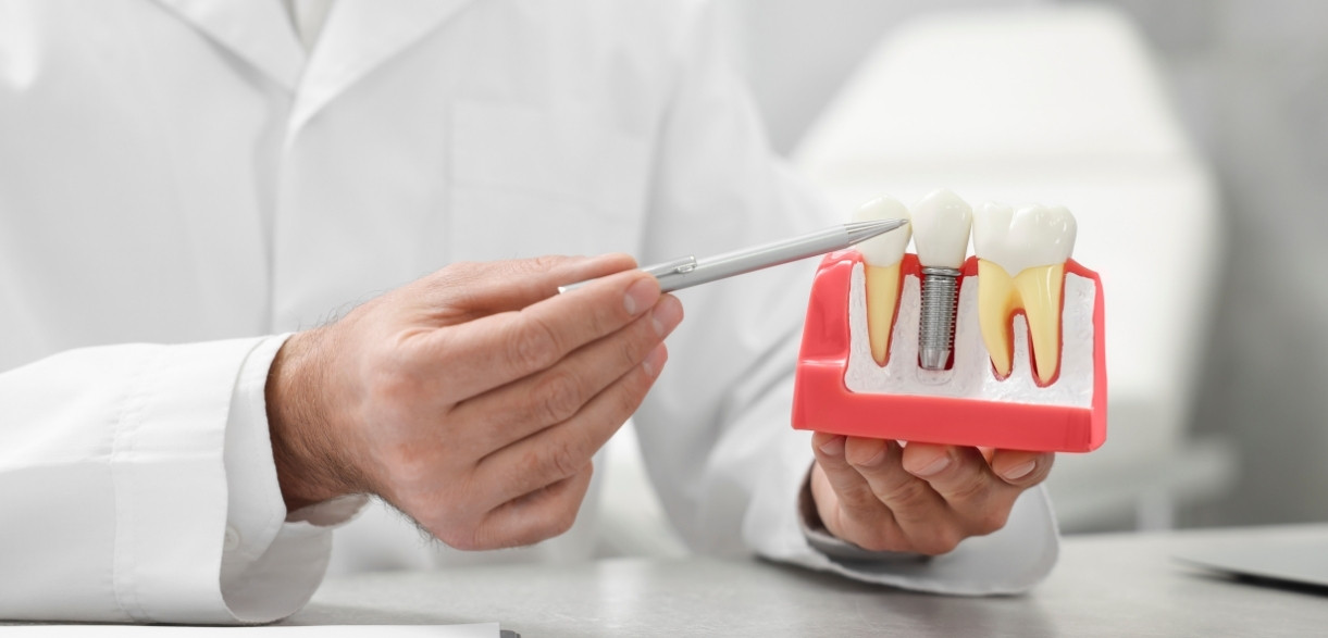 step by step recovery guide for dental implant