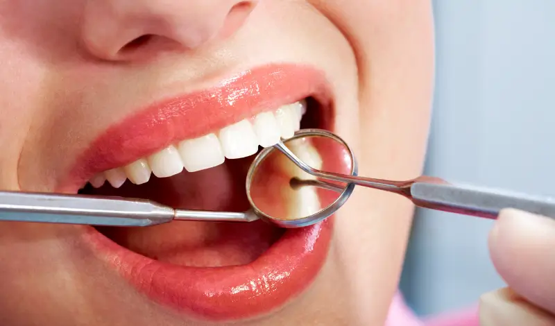 Dental Filling Lifespan