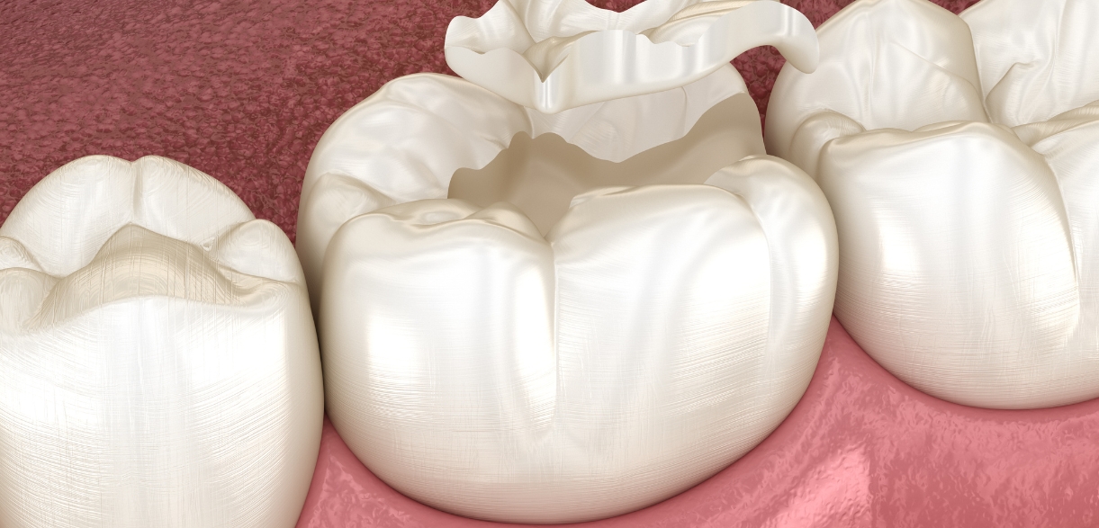Inlays and Outlays an effective fix for damaged teeth