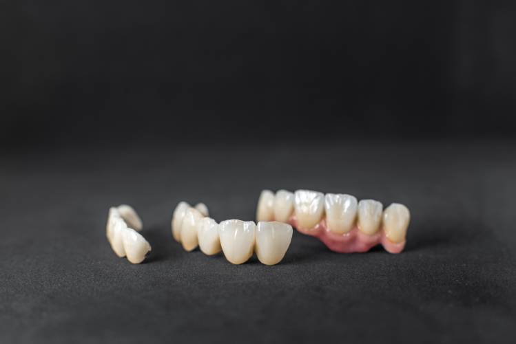 CEREC same-day crowns