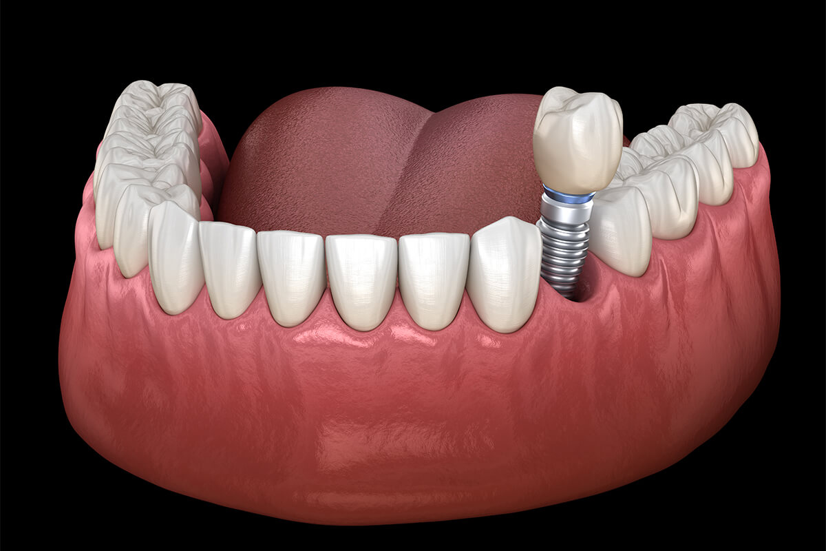 dental implants painful