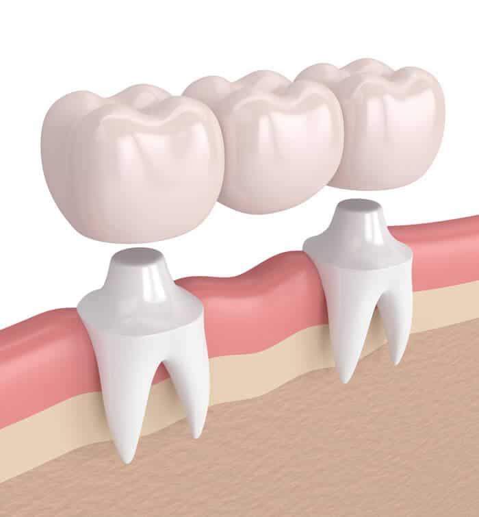 Porcelain Crowns Midwest City - Midwest Smiles