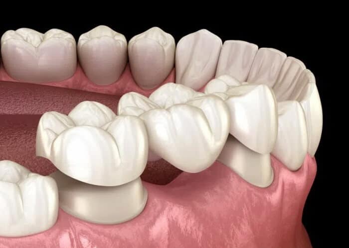 Porcelain Bridges Midwest City - Midwest Smiles