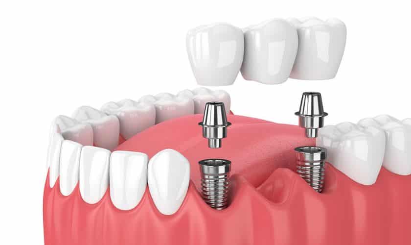 Tooth Replacement Midwest City OK