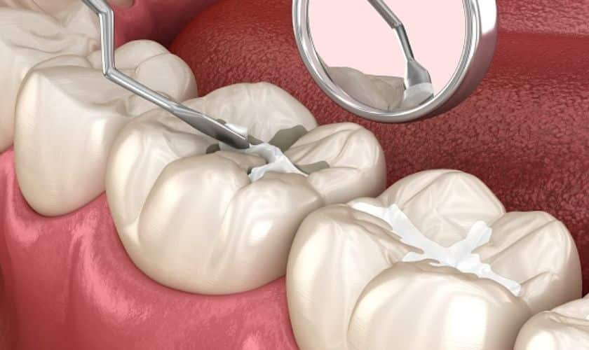 Dental Sealants
