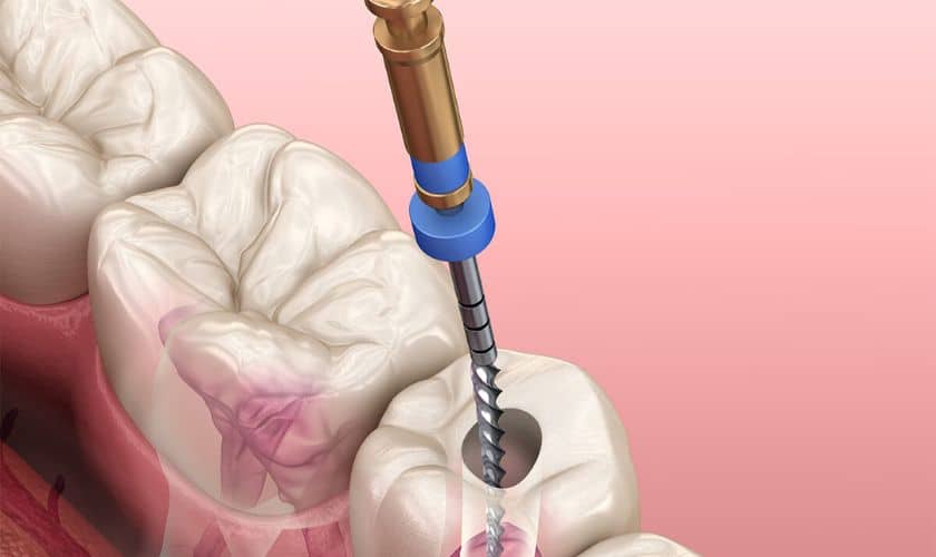 Root Canal Treatment Midewest city Ok