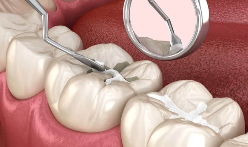 Composite Fillings in Midwest City OK