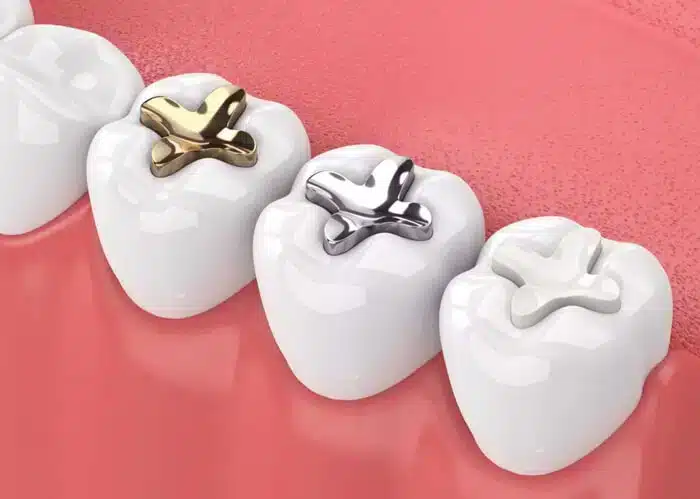 Composite Fillings Midwest City - Midwest Smiles