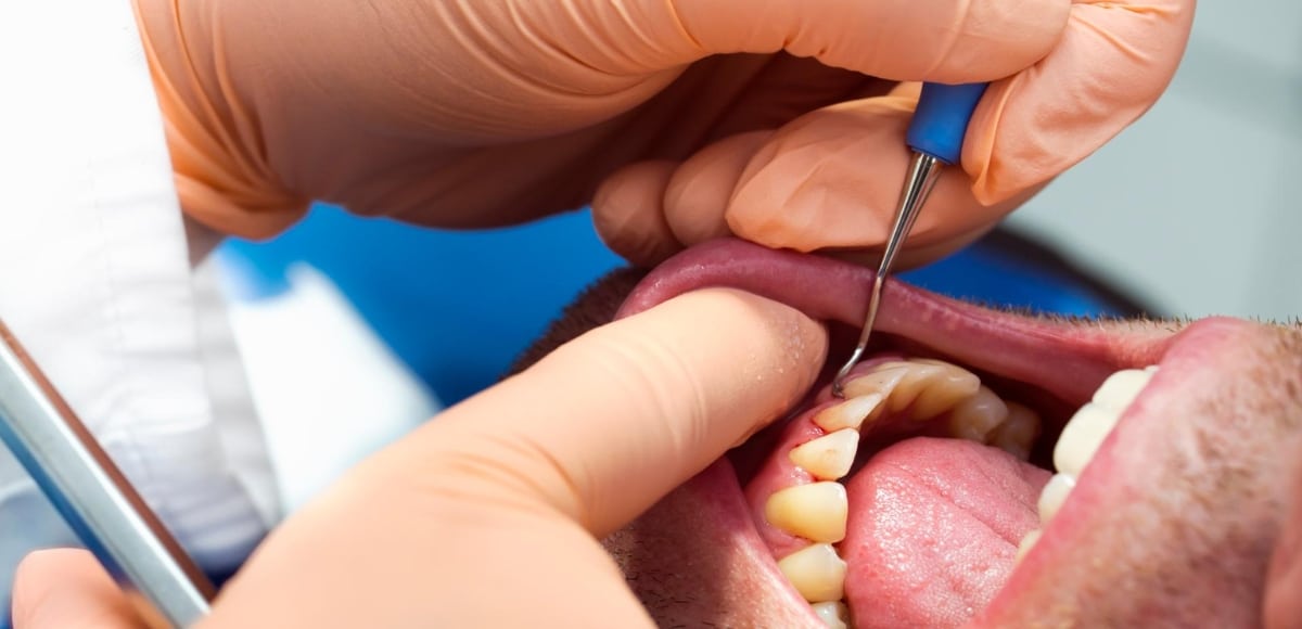 Link Between Cancer And Gum Disease