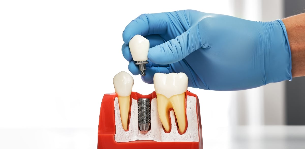Choosing Between Traditional and Mini Dental Implants