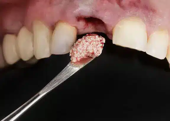 Bone Grafting Midwest City - Midwest Smiles