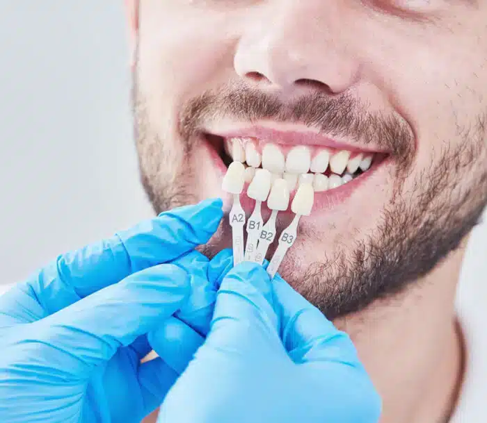 Porcelain Veneers Midwest City - Midwest Smiles